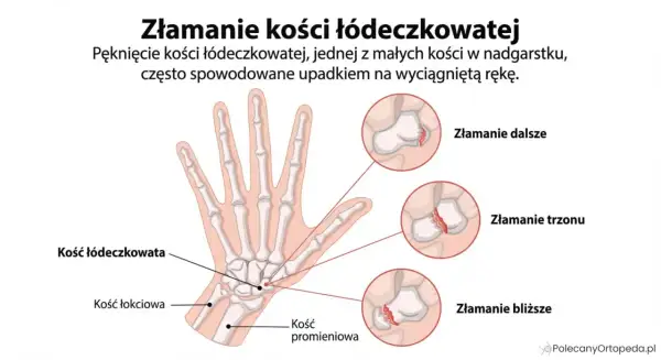 Anatomia dłoni z zaznaczoną kością łódeczkowatą i ilustracjami złamań: dalszego, trzonu i bliższego.