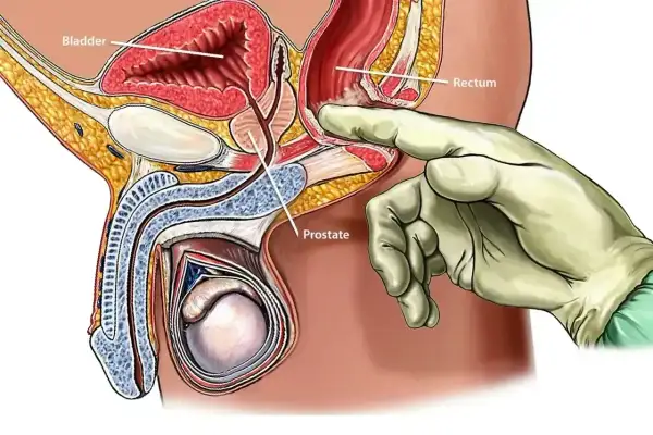 Ilustracja anatomiczna męskiego układu rozrodczego. Ręka w rękawiczce bada prostatę przez odbytnicę, co jest częścią procedury biopsji prostaty.