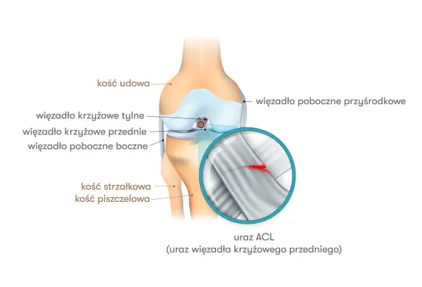 Ilustracja anatomiczna kolana z zaznaczonym zerwanym więzadłem krzyżowym przednim (ACL). Widoczne kości udowa, piszczelowa i strzałkowa.