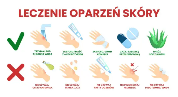 Oparzenie: Złagodź ból! Pierwsza pomoc i czego nigdy nie rób