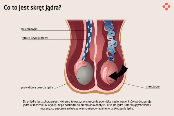 Ilustracja pokazuje skręt jądra, stanowiący przyczynę bólu jądra. Prawidłowa pozycja jądra kontra jądro po skręceniu.
