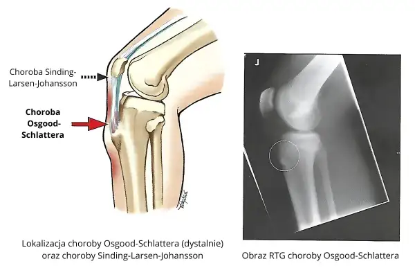 Ilustracja anatomiczna i RTG kolana pokazujące lokalizację choroby Osgooda-Schlattera, która może powodować ból nóg.